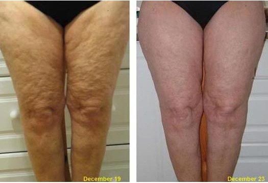 Other: cellulite