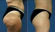 Other: cellulite