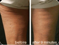 Other: cellulite