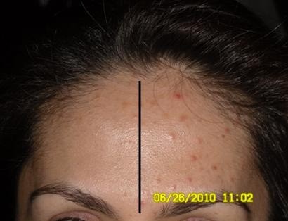 Other: Acne